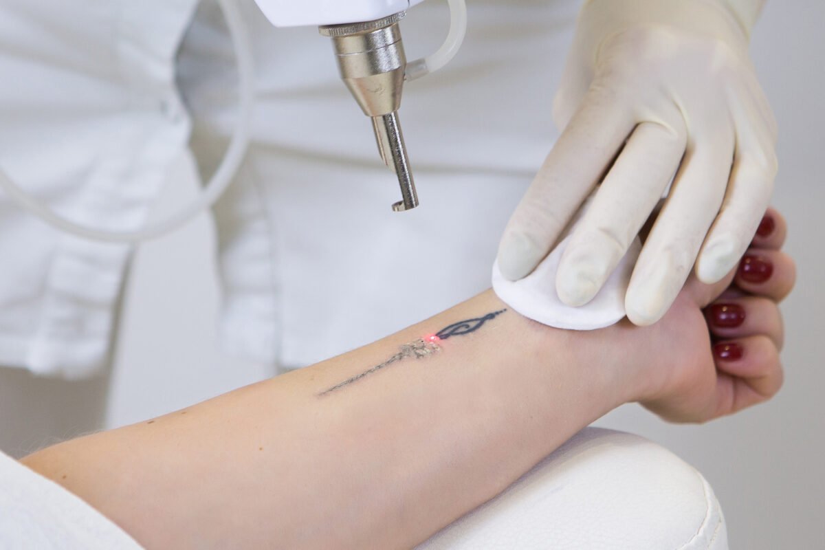 Laser-tattoo-removal-1-1200x800.jpg