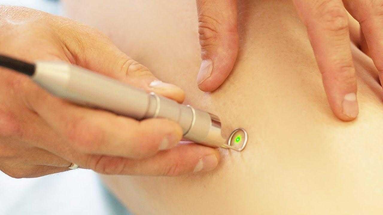 https://epidermal.com.tr/wp-content/uploads/2023/10/lazer-varis-tedavisi.jpg